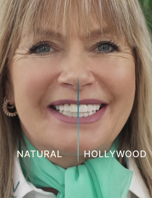 Tooth-veneer colour comparison with a woman smiling 