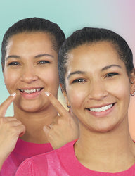 Comparison showing a woman with and without veneera veneer